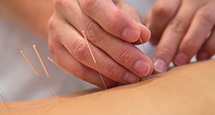 Close-up of acupuncture needles with a patient