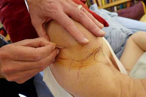 hands using an acupuncture needle on a person's shoulder